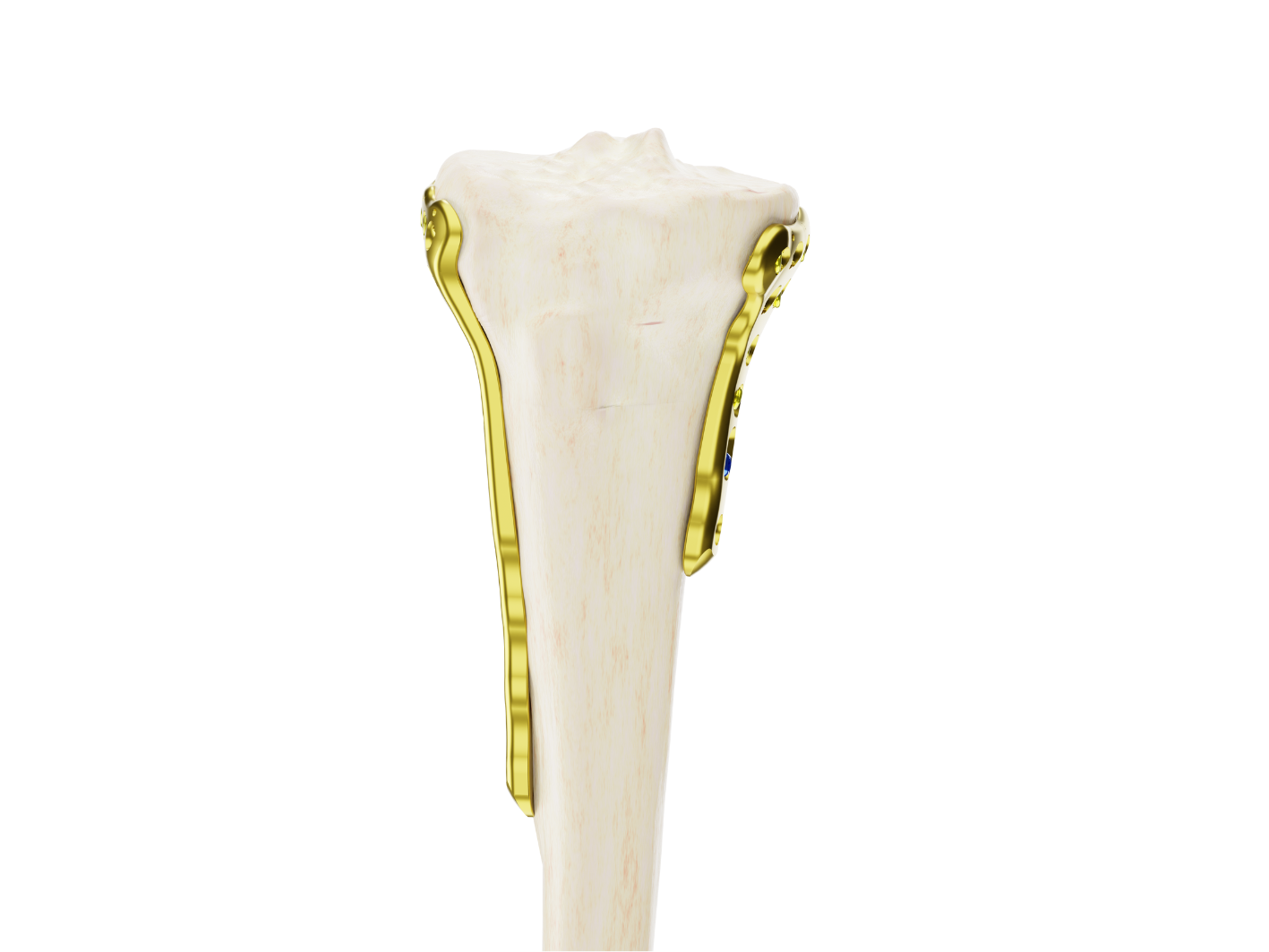 Affinity Tibia Proximal - Imagen 4