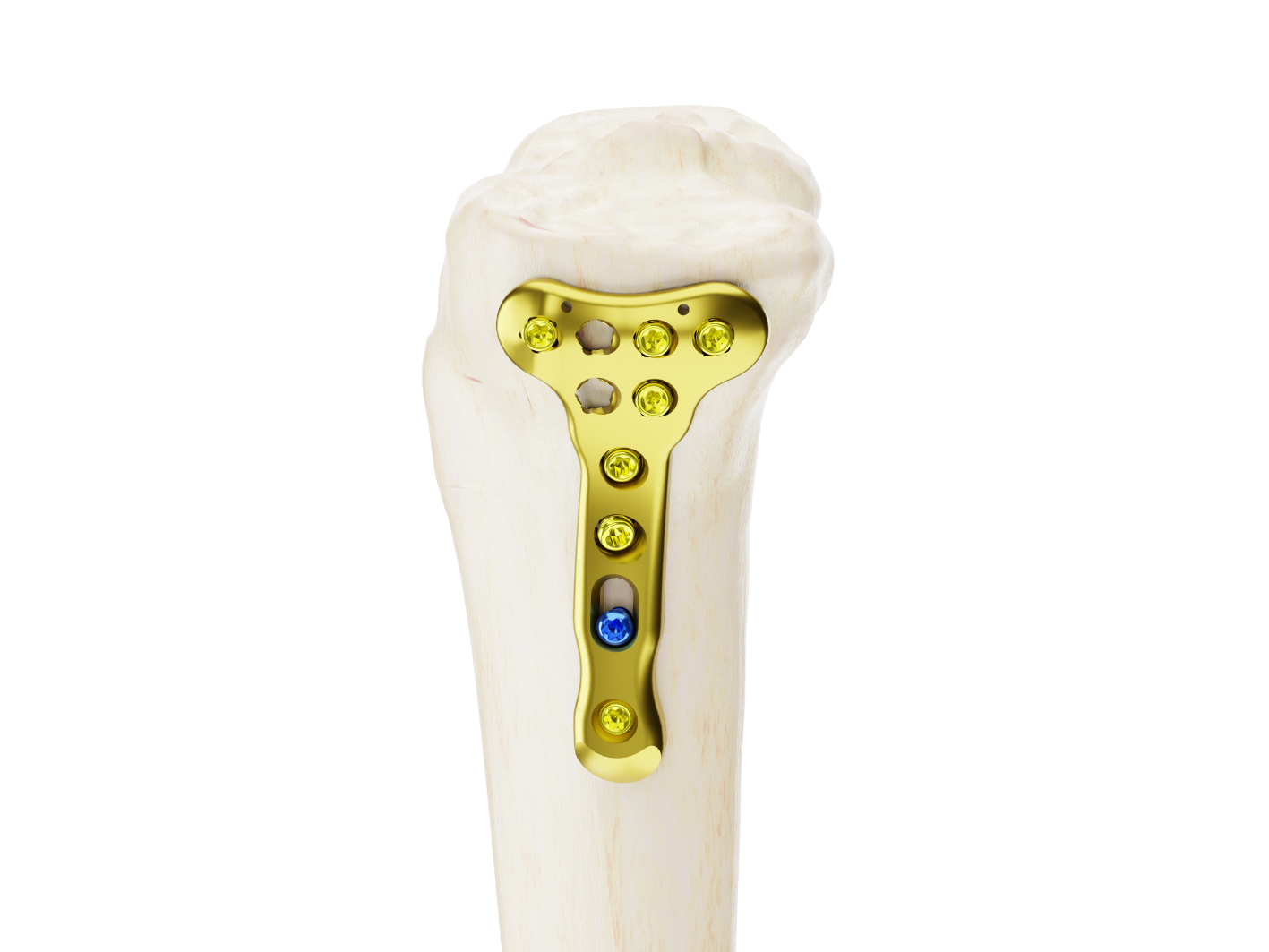 Affinity Tibia Proximal - Imagen 2