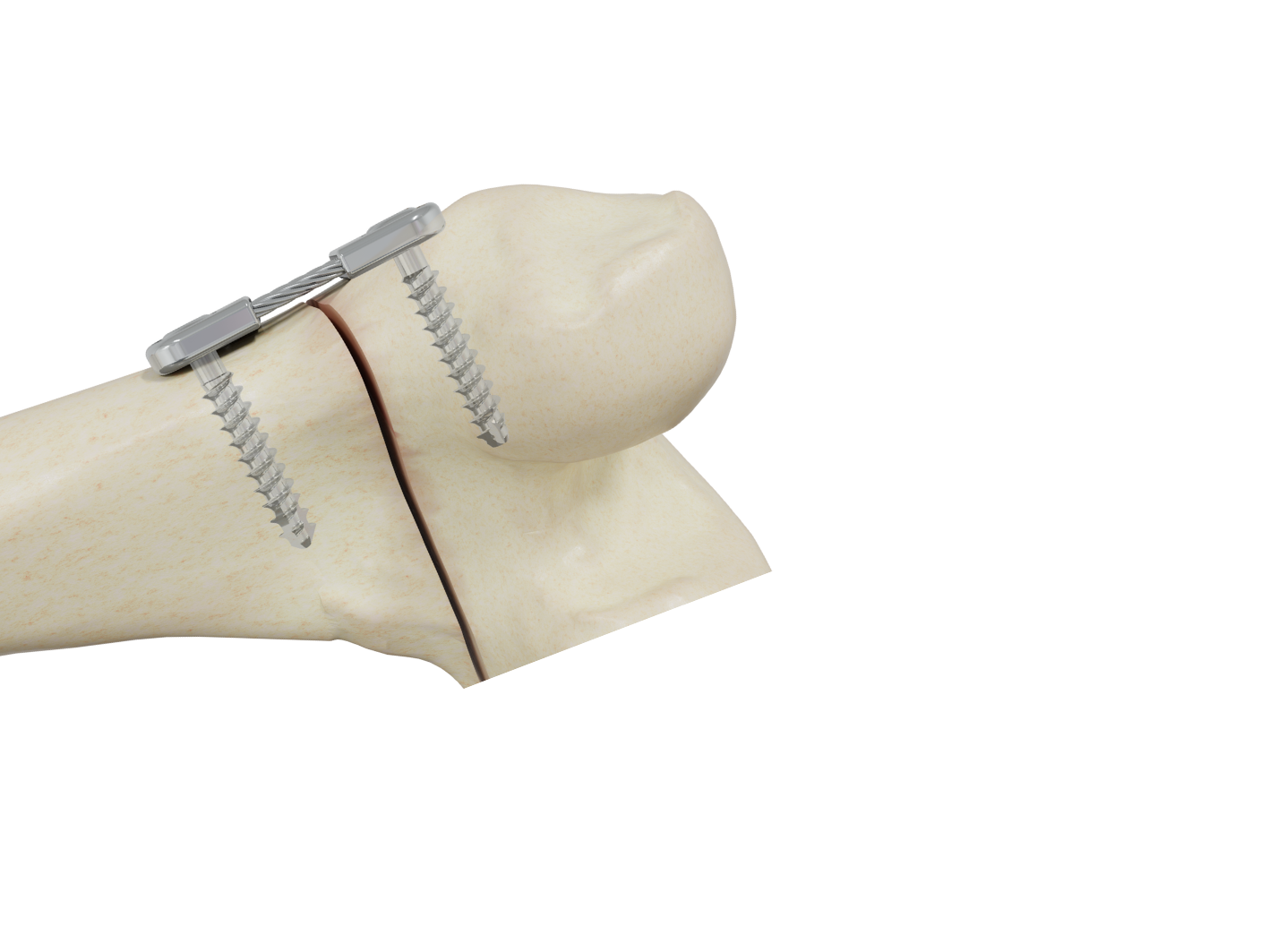 Epiflex - Imagen 2