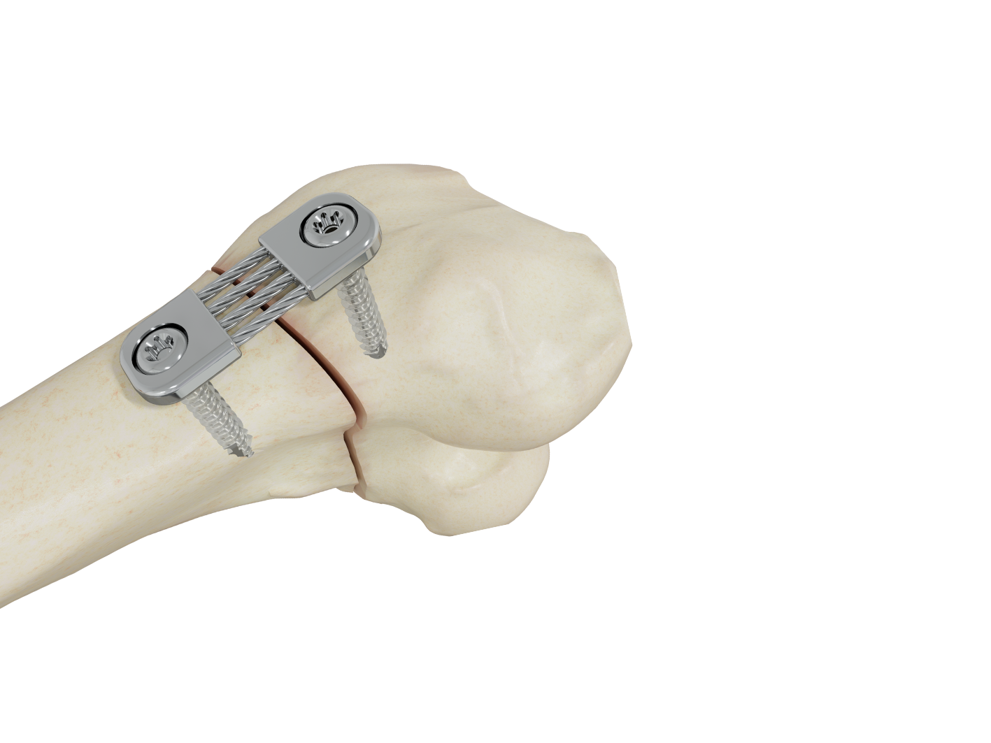 Epiflex