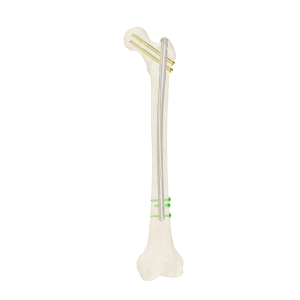 Clavo Support Reconstrucción Femoral