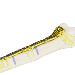 Placa Extralarga Affinity Radio Distal